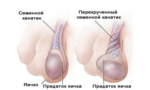 Перекрут левого яичка Perekrut levogo jaichka