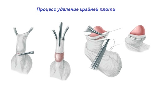 Процесс удаление крайней плоти Process udalenie krajnej ploti
