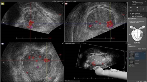 Пункционная биопсия Punkcionnaja biopsija