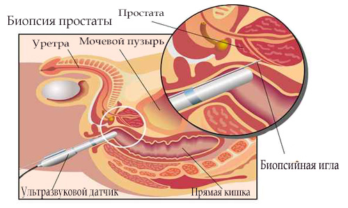 Схема биопсии предстательной железы Shema biopsii predstatel'noj zhelezy