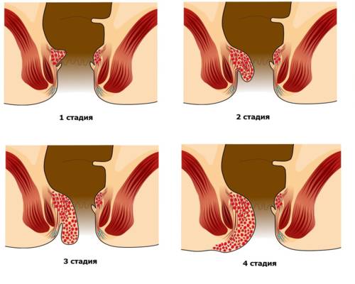 Stadii gemorroja