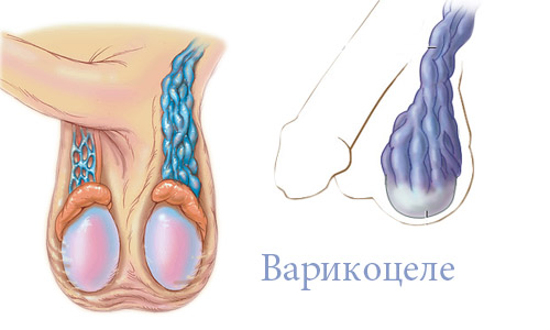 Varikocele
