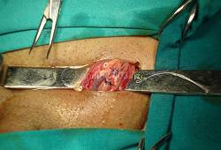 Varikocele operacija