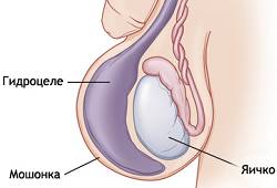Водянка яичка Vodjanka jaichka