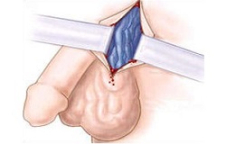 Zabolevanie varikocele