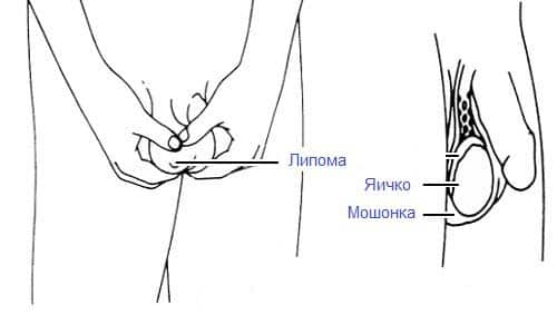 Липома на мошонке