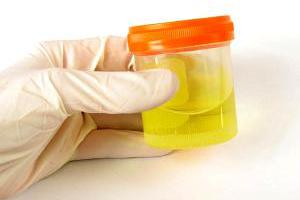 Анализ мочи