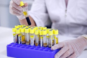 Мазок из уретры у мужчин