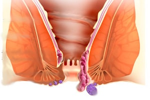 Геморроидальные узлы Геморроидальные узлы