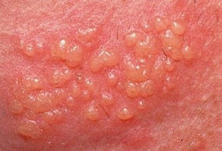 Генитальный герпес у мужчин genital'nyj gerpes u muzhchin