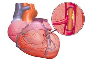 Приобретение ишемической болезни