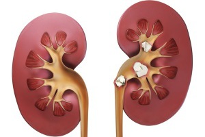 Образование камней