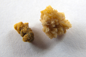 Образование камней Образование камней