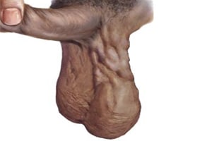 Дискомфорт при варикоцеле