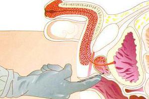 Стимуляция простаты