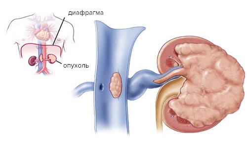 онкология почки onkologija pochki