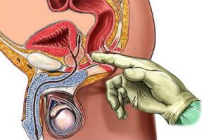 Пальпация простаты
