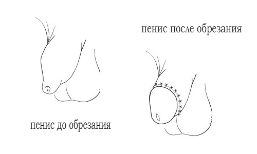 пенис до и после обрезания penis do i posle obrezanija