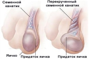 Перекрут железы Перекрут железы