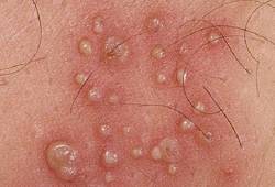 Прыщи на половом члене polovoj gerpes u muzhchin