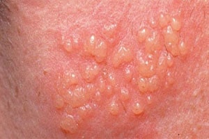 Половой герпес