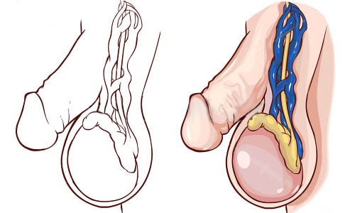 posledstvija varikoza u muzhchin