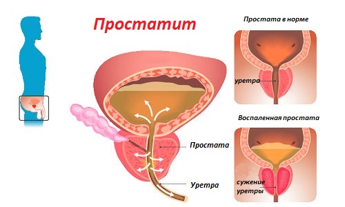 raspolozhenie prostaty