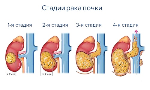 стадии рака почки stadii raka pochki