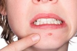 Подростковые угри