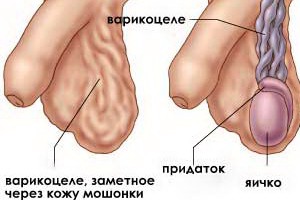 Признаки варикоцеле