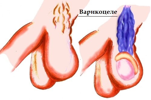 varicocele