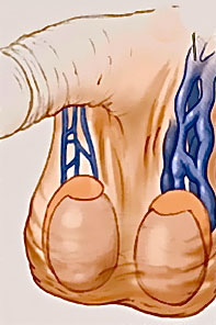 Варикоцеле у мужчин varikocele