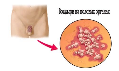 Волдыри на половых органах