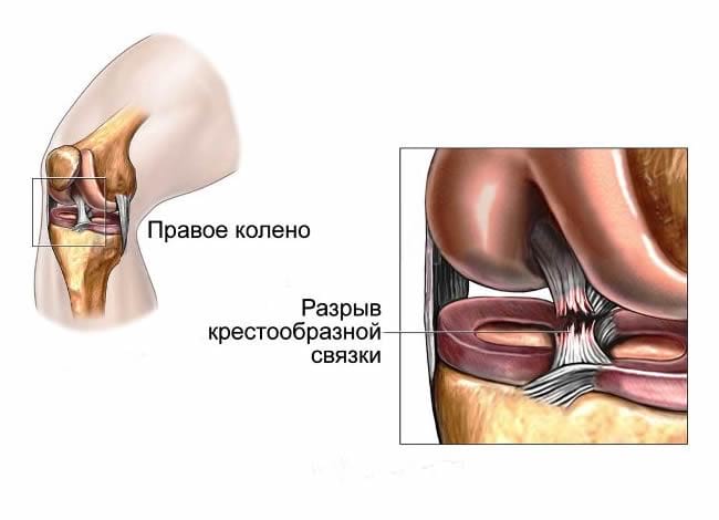 Разрыв передней крестообразной связки
