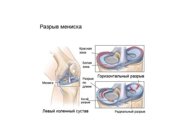 Травма мениска коленного сустава