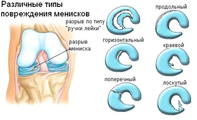 Виды повреждений мениска коленного сустава