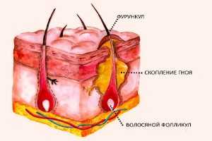 Фурункул, карбункул и абсцесс кожи - лечение