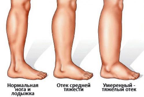 Что делать при отеках: виды и причины отеков, как избавиться от отеков