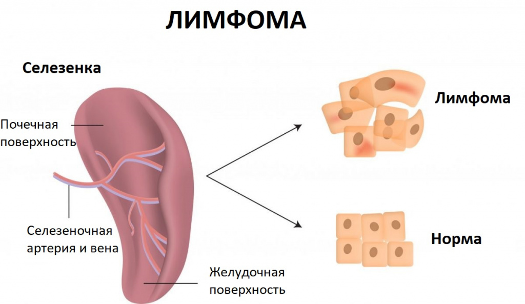 Лимфома.jpg Лимфома.jpg