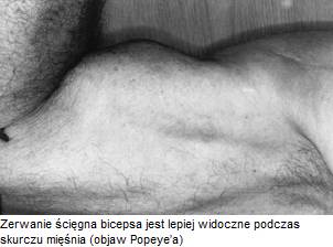 Повреждение сухожилия бицепса