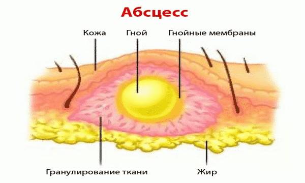 Абсцесс кожи Абсцесс кожи