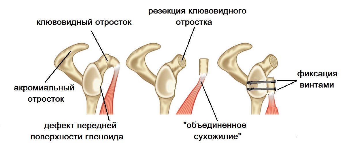 операция латерже