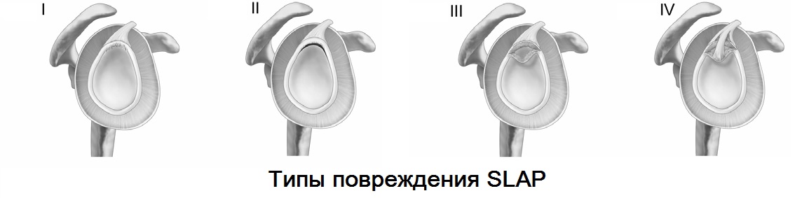 повреждение SLAP