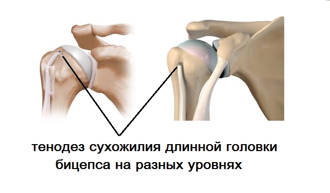 лечение плеча