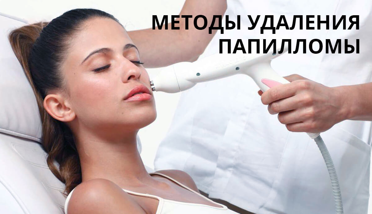 Методы удаления папилломы