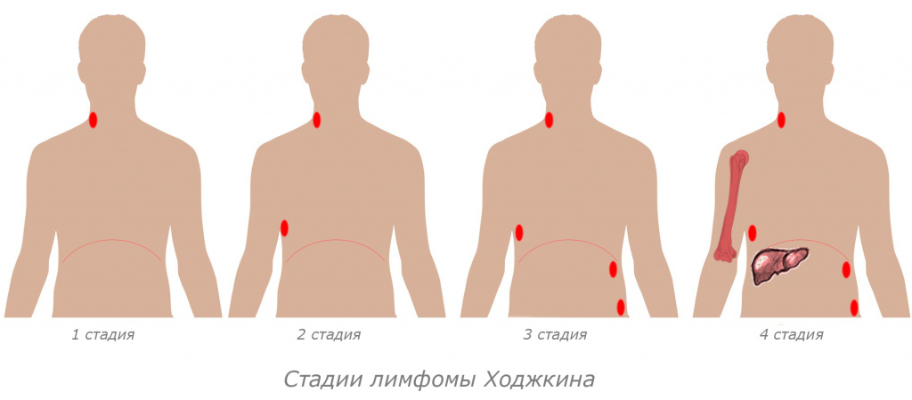 Лимфома Ходжкина.jpg Лимфома Ходжкина.jpg