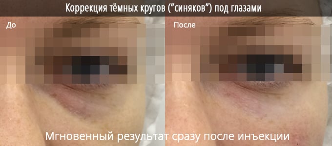 Как убрать тёмные круги под глазами