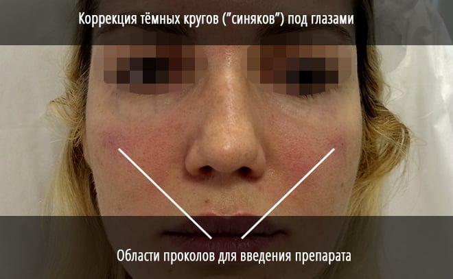Удаление мешков под глазами