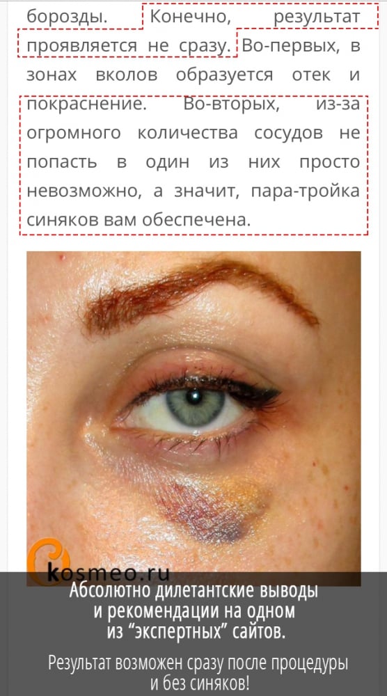 Удаление мешков под глазами