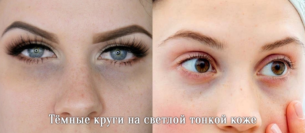 Тёмные круги и синяки под глазами - причины возникновения и методы коррекции
